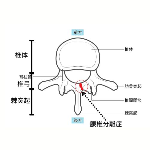 腰椎分離症