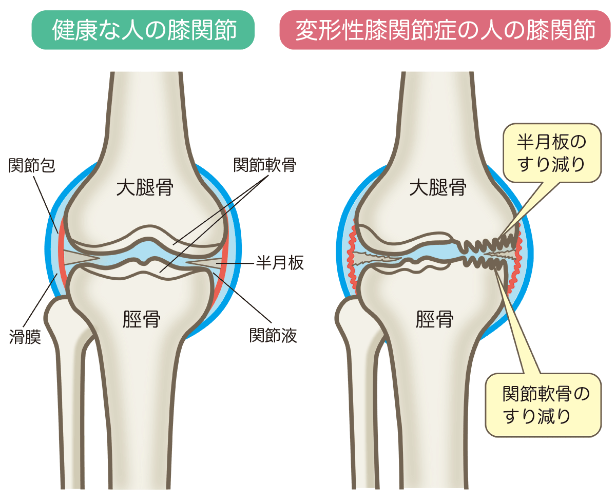 膝関節の比較